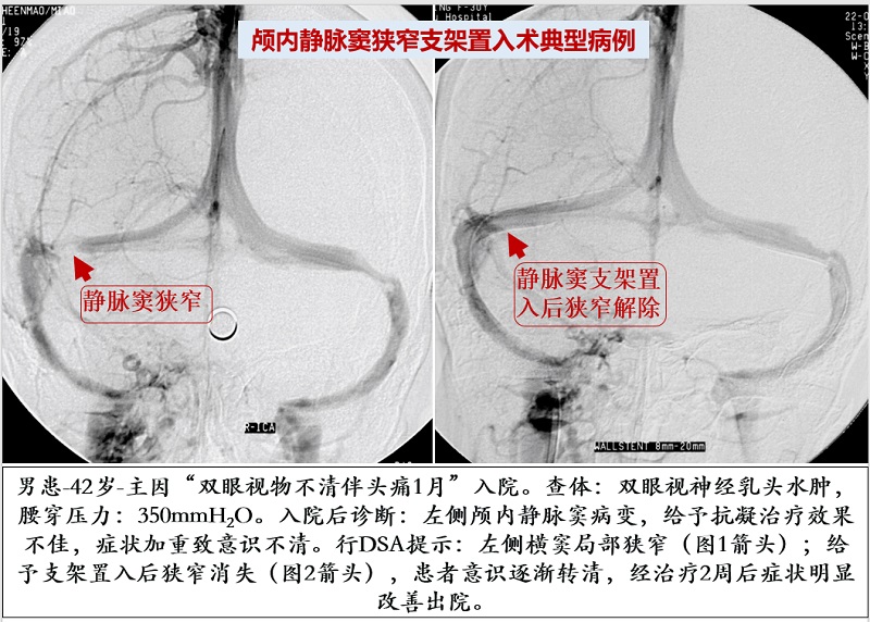 颅内静脉窦血栓形成或狭窄血管内治疗术神经内科